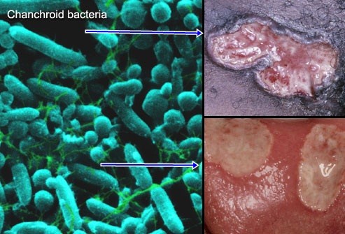 cara mengobati sipilis pria dengan bawang putih