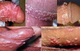 sipilis bisa sembuh total