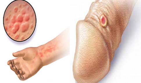 Obat Sipilis Farmasi